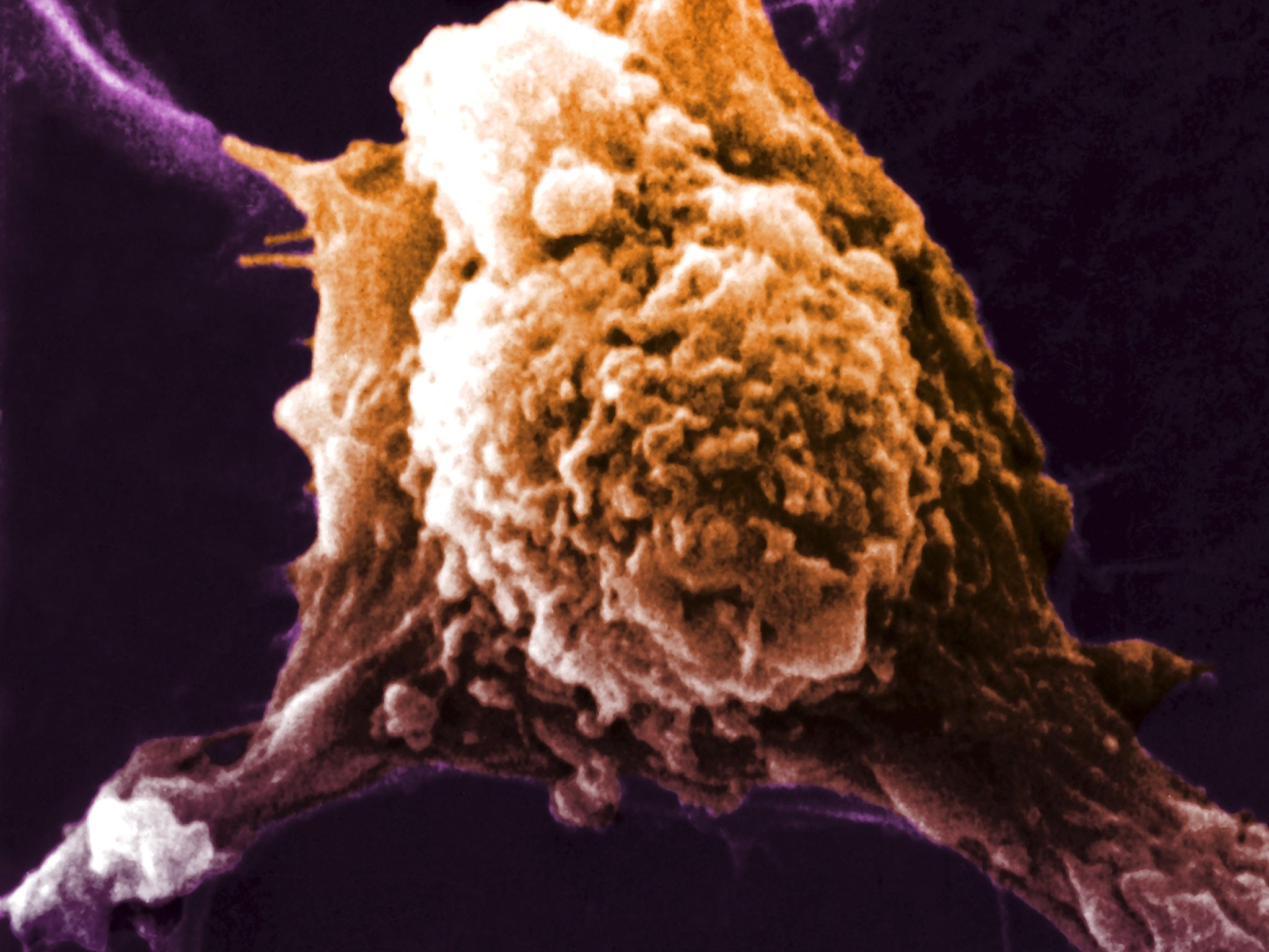 'Universal cancer vaccine’ breakthrough claimed by experts